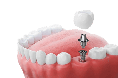 Conventional And Basal Implants